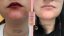 Ekzém na bradě -  foto "před a po" používání balzámu DermaFood
